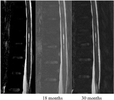 Prospective Follow-up of Intramedullary Slitlike Cavities: A Consecutive Series of 48 Patients